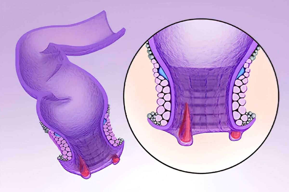 Anal-Fissure-Αρχική-1200x800.jpg